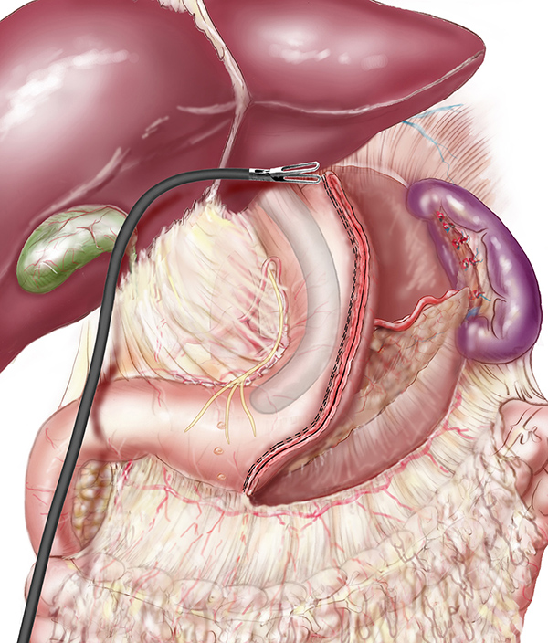 découvrez comment le bypass gastrique favorise une perte de poids significative, ses avantages, le déroulement de l'intervention et des conseils pour réussir votre transformation.